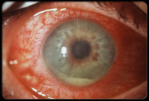 A study released by Ophthalmology Times suggested that eye bacteria are becoming more resistant to older types of antibiotics (tumblr.com)