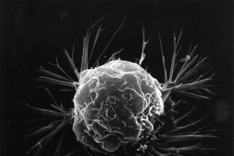 Breast cancer cell (Wiki Commons)