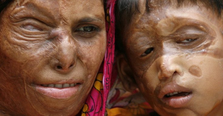 Acid Attack Survivors