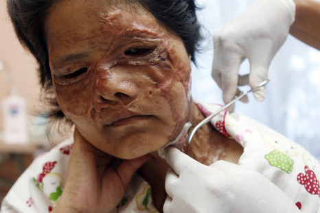 Acid Attack Survivor