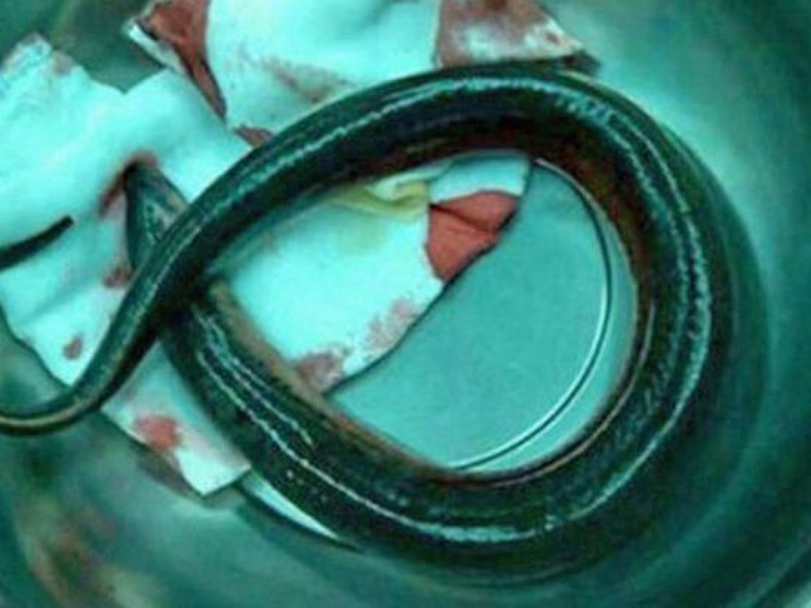 Eel chews through man's intestine after he swallowed them alive to