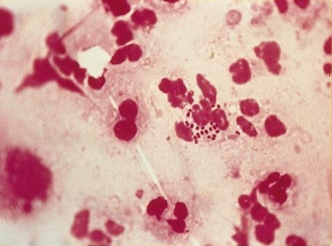 The Gonorrhoea superbug strain could become untreatable and reach epidemic proportions by 2015. (Wikimedia Commons) The Gonorrhoea superbug strain could become untreatable and reach epidemic proportions by 2015. (Wikimedia Commons)