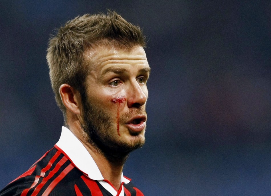 David Beckham bleeds from his cheek as he looks on during the Italian serie A soccer match against Chievo in Milan March 14, 2010.