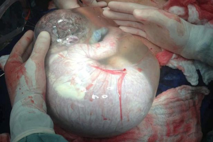 Baby in Amniotic Sac