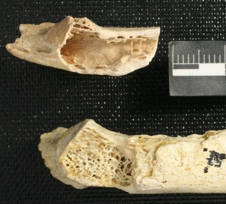The cancerous bone is a 30-millimeter-long fragment of the left rib (University of Kansas)