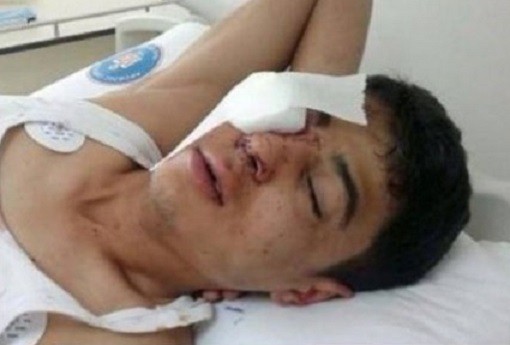 Lost vision: A protester recovers after being hit in the eye with a police teargas cannister. Ten people are said to have been blinded