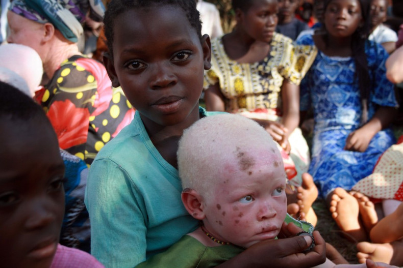 Albino Tanzania