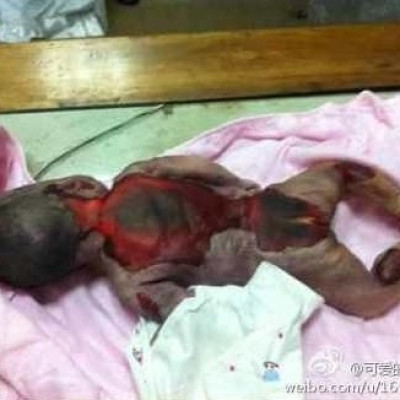 Faulty Incubator at Chinese Hospital Burns Newborn Baby to Death (PHOTOS)