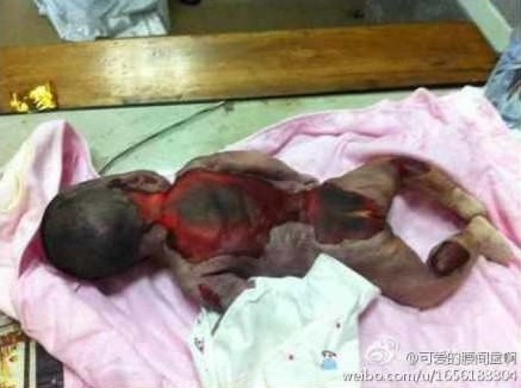 Faulty Incubator at Chinese Hospital Burns Newborn Baby to Death (PHOTOS)