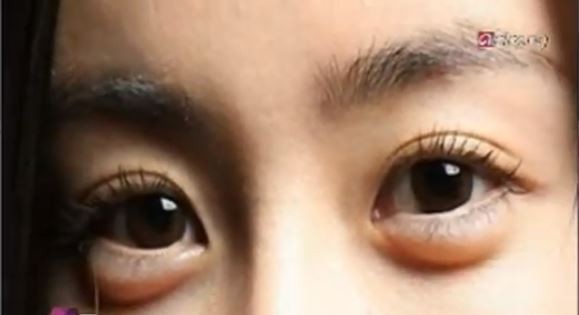 Aegyo Sal Korean Women Have Surgery to Make Eyes Puffy and Baggy