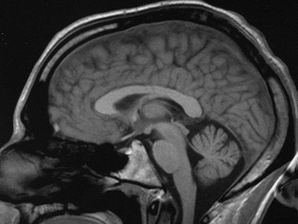 Brain scan