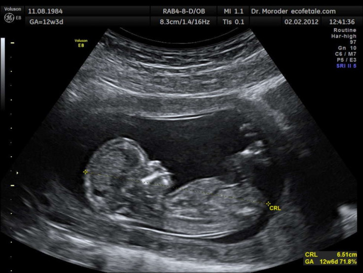 Ultrasound image of a fetus