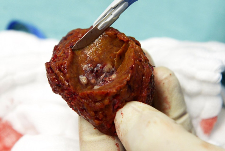 A tumor inside a piece of a liver which was removed during surgery, one of the first surgeries of its kind in Germany with the support of a tablet computer. (Photo: REUTERS/Fabian Bimmer)