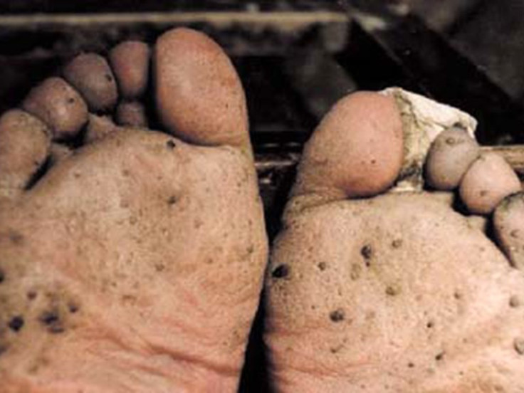 Advanced case of hyperkeratosis on the sole and toes resembles fish scales (© China Medical University, Shenyang)