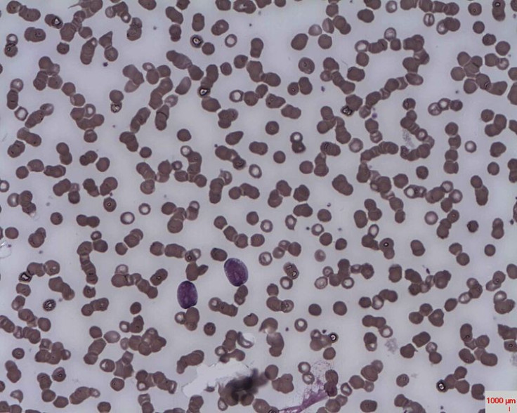 acute lymphoblastic leukaemia