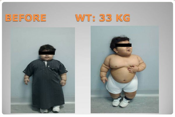 Obese child
