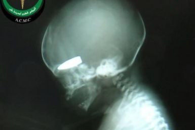 A bullet lodged lodged in the skull of a full-term foetus. (Syria Relief)