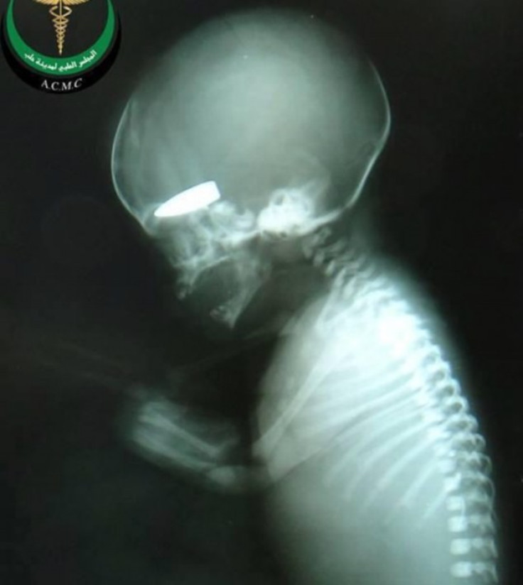 A bullet lodged lodged in the skull of a full-term foetus. (Syria Relief)