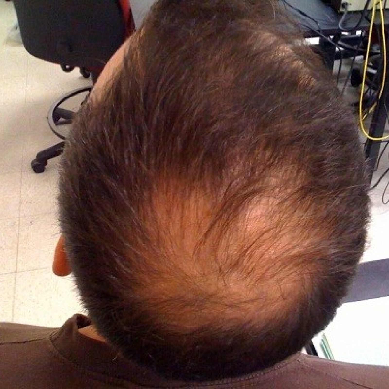 Have scientists discovered the cure for baldness?