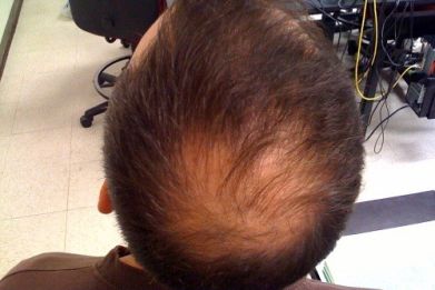 Possible Treatment for Baldness and Hair Restoration is here