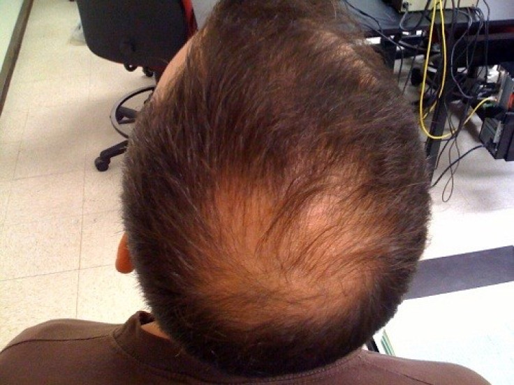 Possible Treatment for Baldness and Hair Restoration is here