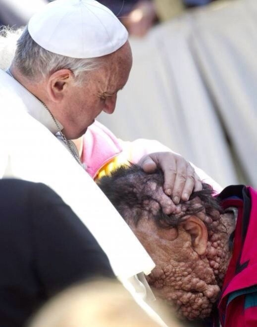 Pope Francis Kisses Disfigured Man Pope Francis Kisses Disfigured Man