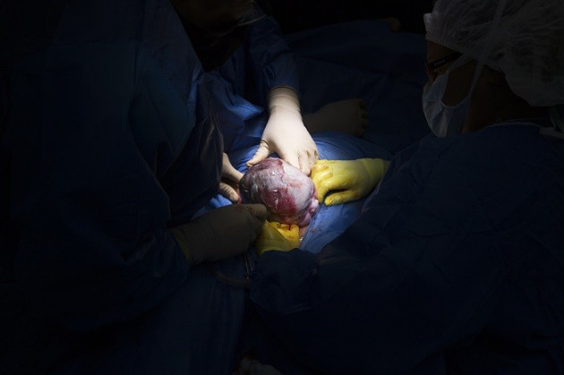 Caesarean section Caesarean section
