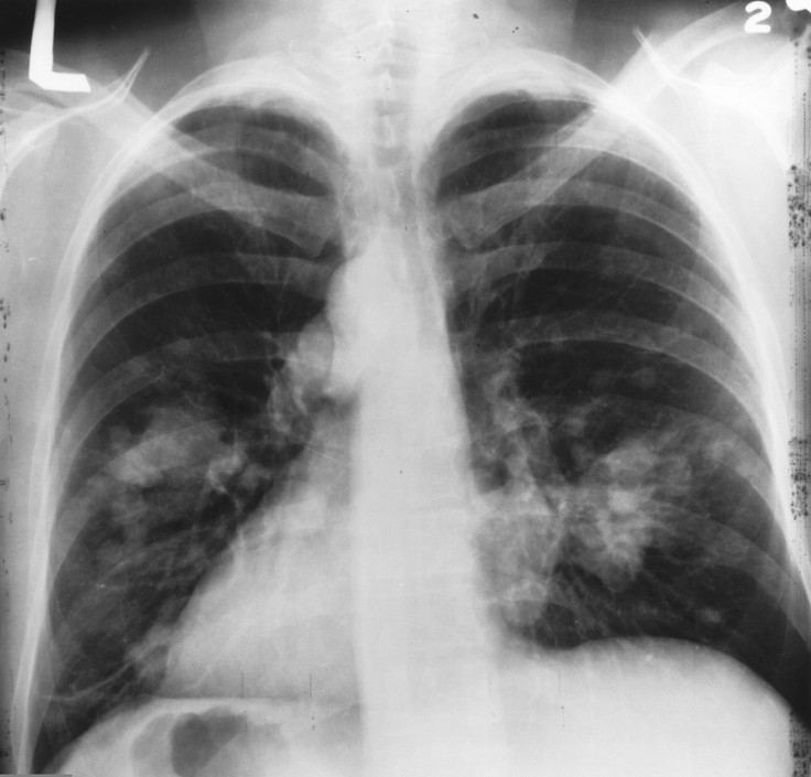Lung cancer