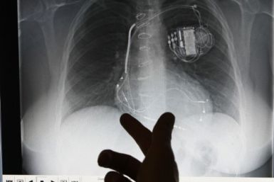 Implantable cardioverter defibrillators, or ICDs, deliver a jolt of electricity to correct life-threatening heart rhythms and cost upwards of $35,000 each