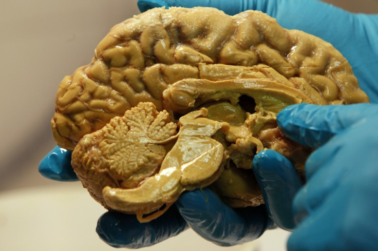 Alzheimer's Disease Alzheimer's Disease